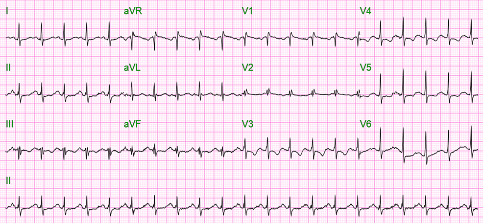 EKG-al-ingreso-que-muestra-taquicardia-sinusal-con-frecuencia-ventricular-de-125/min-y-QTc-de-574-ms