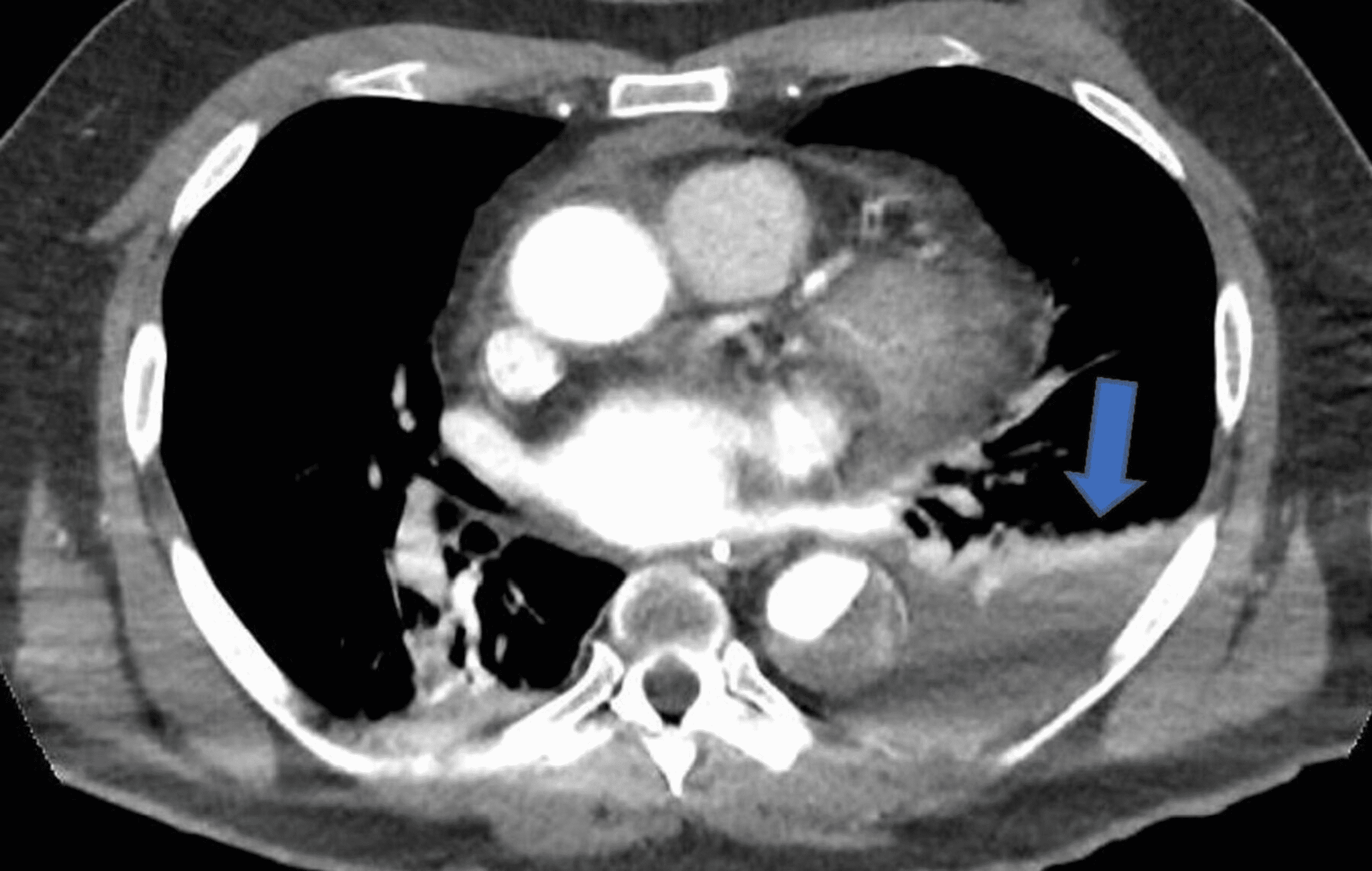 Cureus | An Unusual Presentation Of Type B Aortic Dissection As Out-of ...