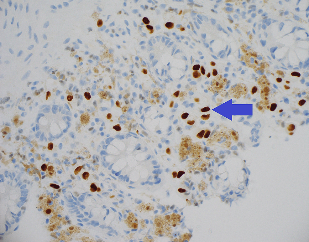 Biopsie aleatorie a colonului ascendent cu colorație cu imunoperoxidază GATA3