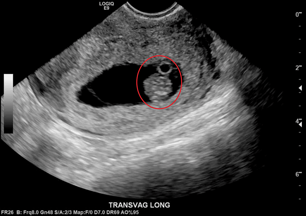 diagnosis-of-intrauterine-pregnancy-despite-the-presence-of