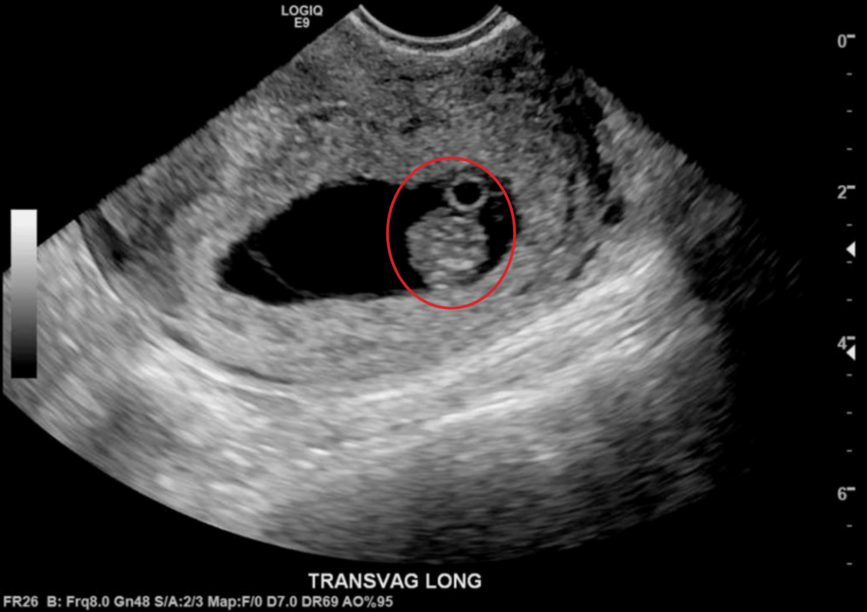 Cureus Diagnosis Of Intrauterine Pregnancy Despite The Presence Of Etonogestrel Implant