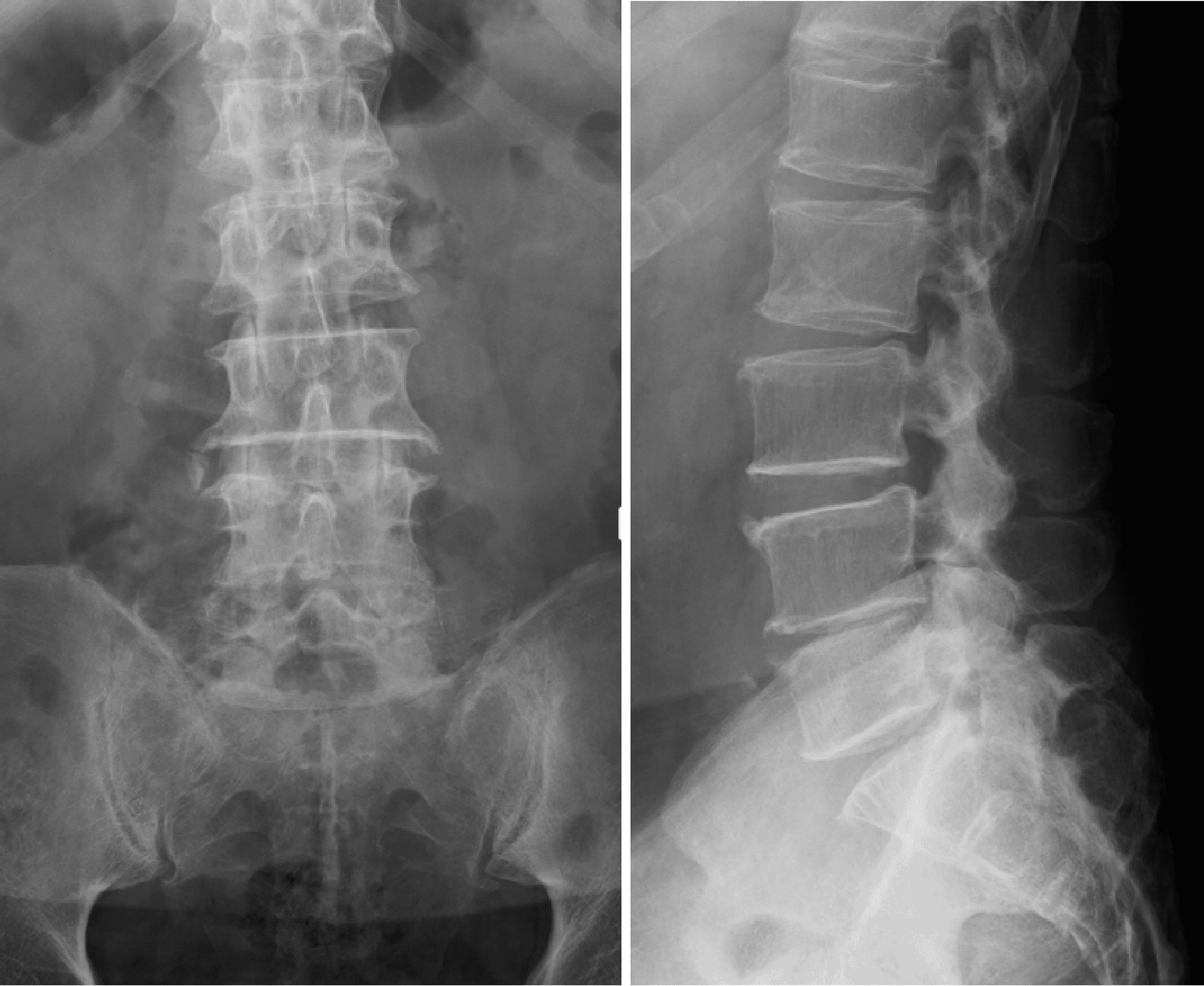 Cureus | First Case of Pyogenic Spondylodiscitis Caused by Gemella ...