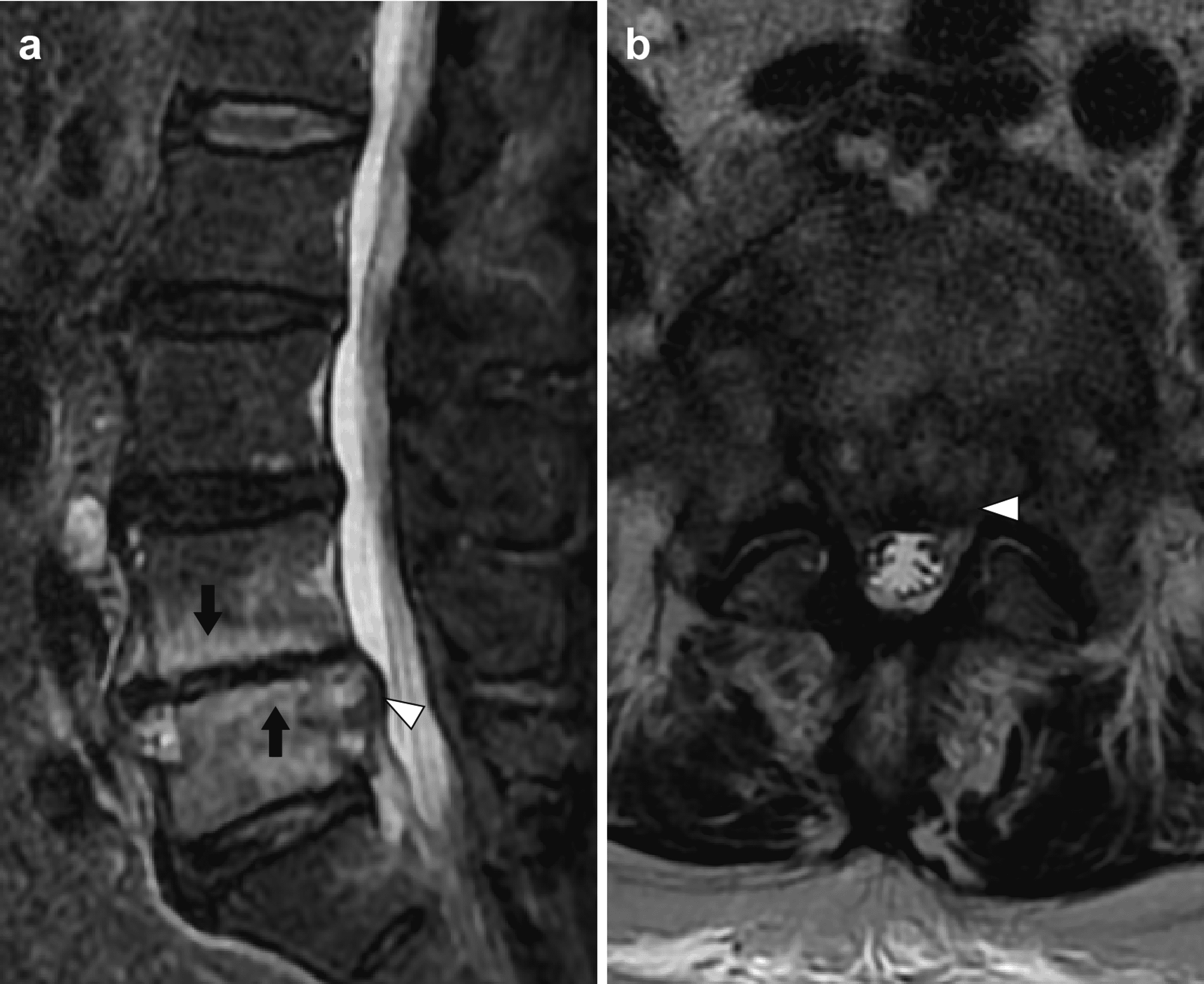 Cureus | First Case Of Pyogenic Spondylodiscitis Caused By Gemella ...