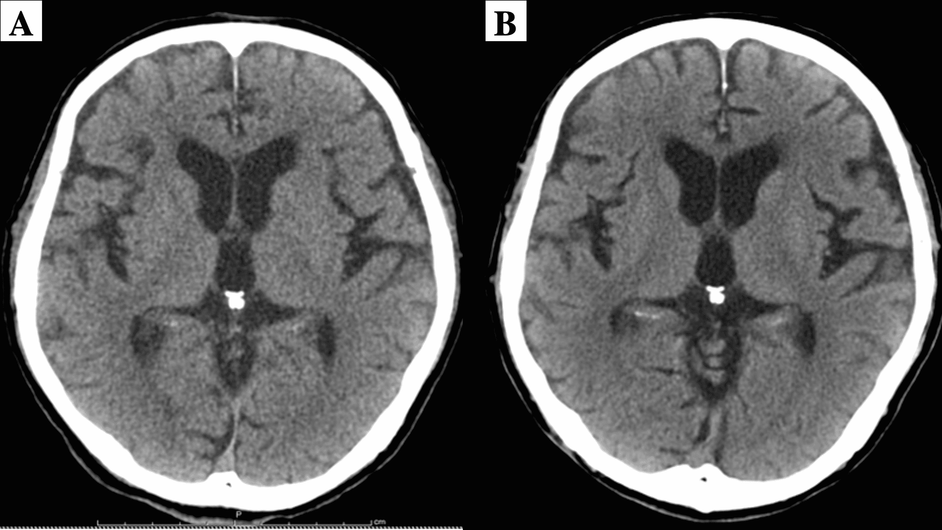 Cureus | Food Aspiration Induced Hypoxic Encephalopathy Leading to ...