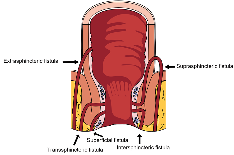 Illustration-of-fistula-classification