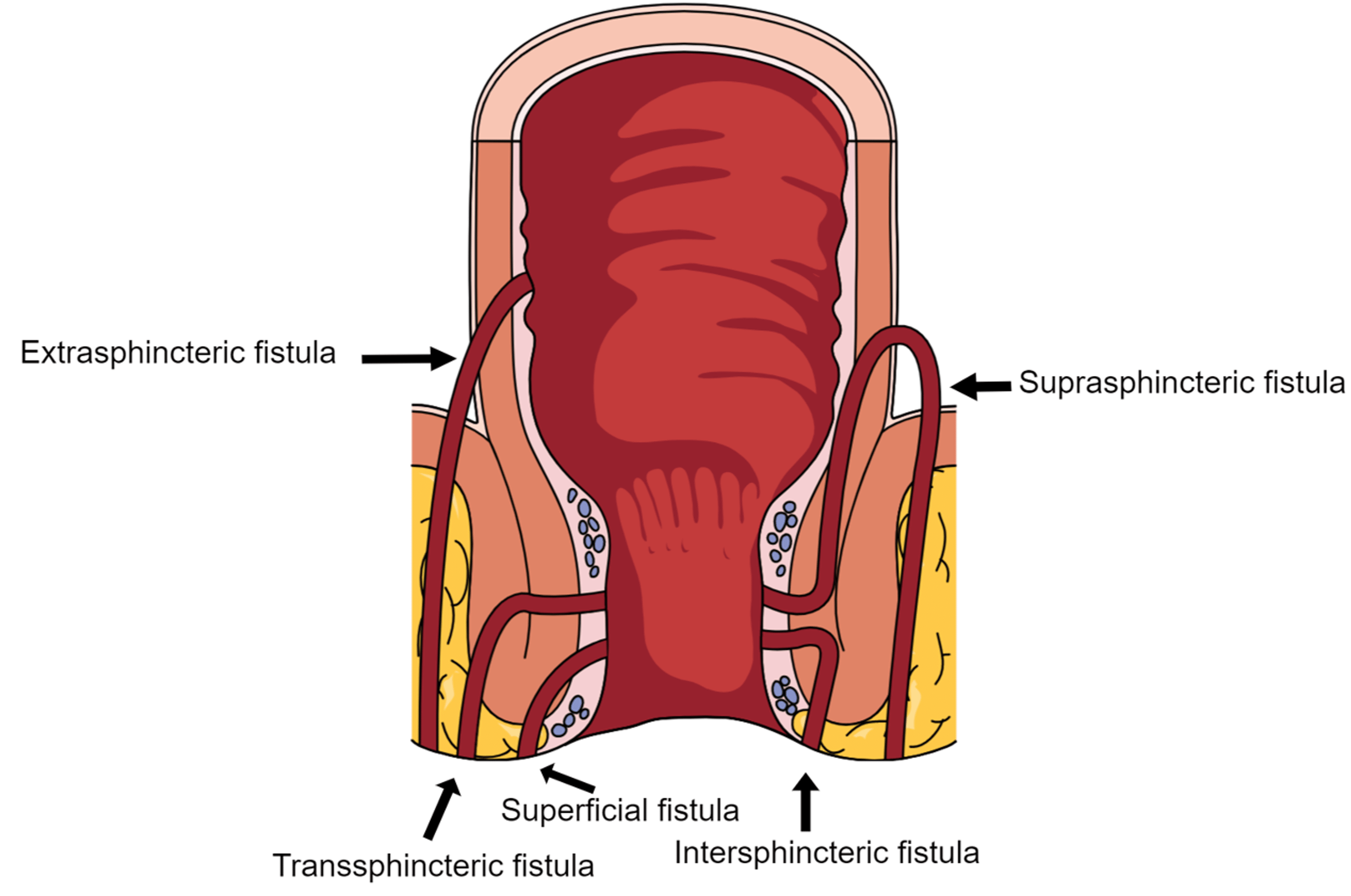 Cureus The Multidisciplinary Management Of Perianal Fistulas In Crohn 