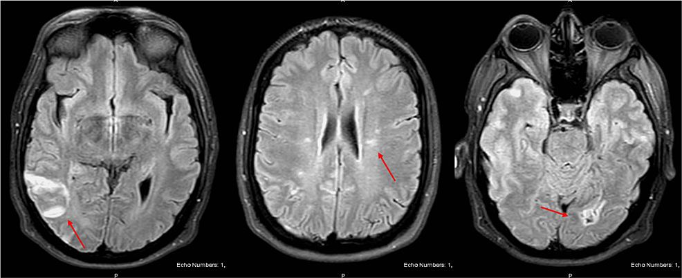 Cureus | Atrial Myxoma Presenting as an Atypical Stroke in a Young ...