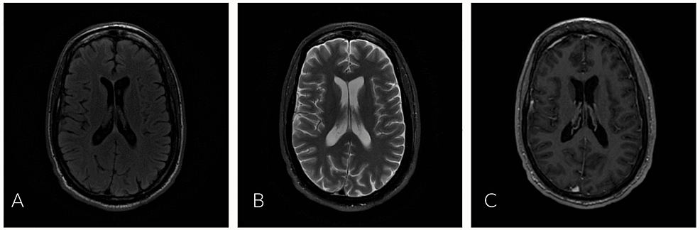MRI-brain:-axial-images-with-and-without-contrast