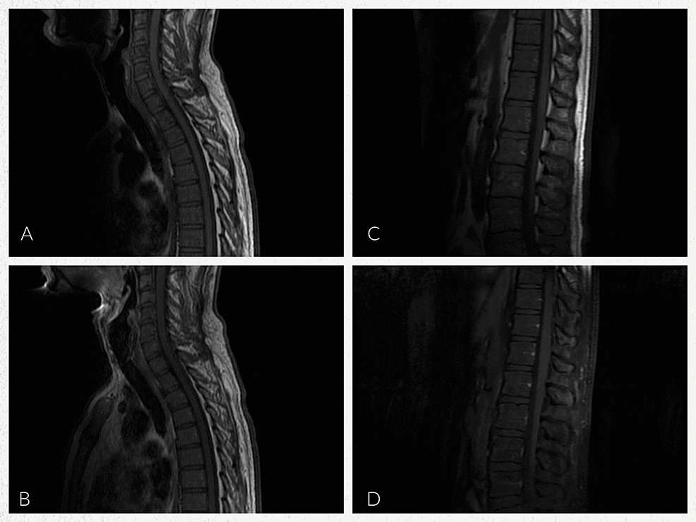 MRI-cervical,-thoracic,-and-lumbar-spine-with-and-without-contrast