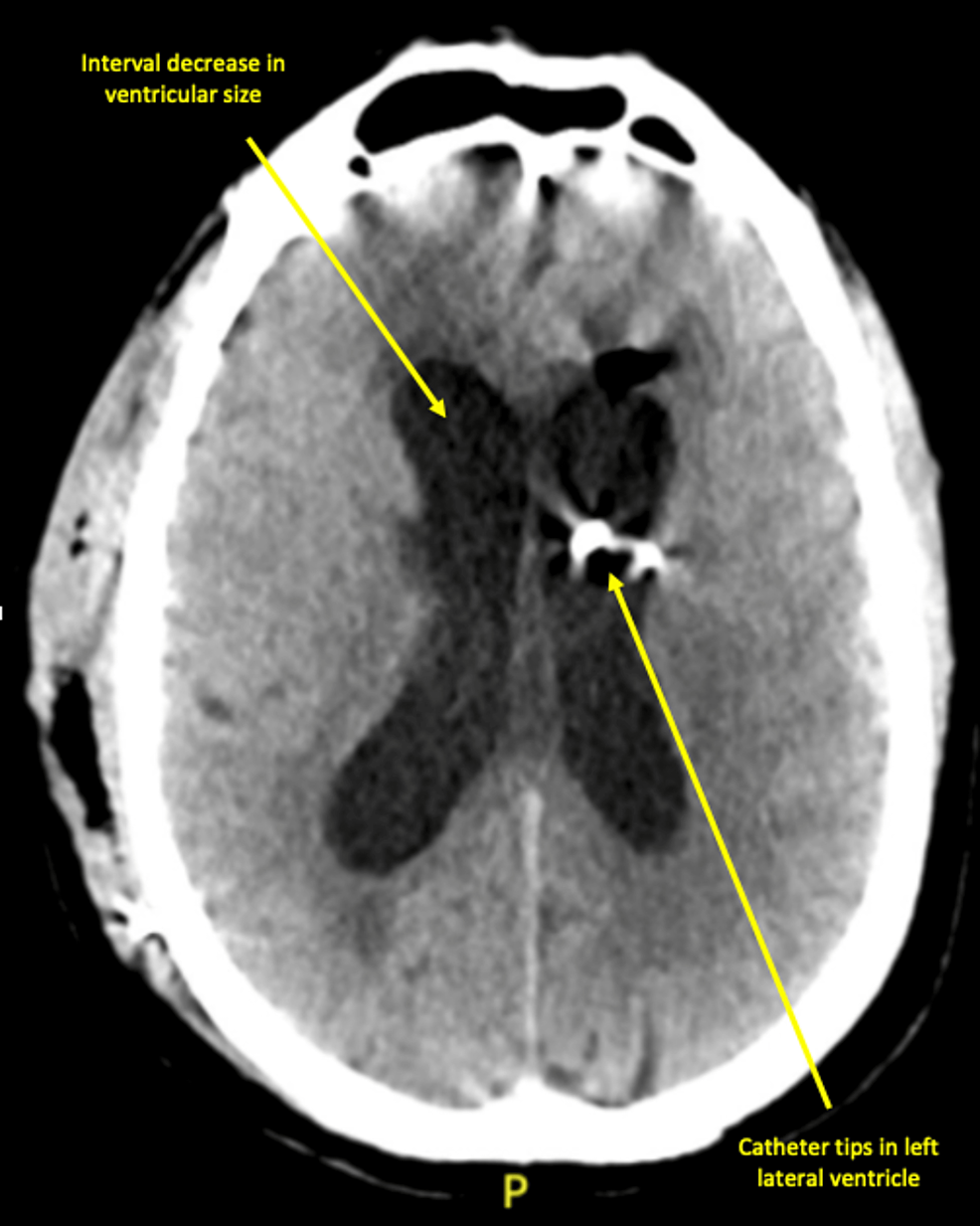 CT-head-without-contrast-on-day-19-of-admission-revealed-an-interval-decrease-in-ventricular-size-and-catheter-tips-in-the-left-lateral-ventricle.
