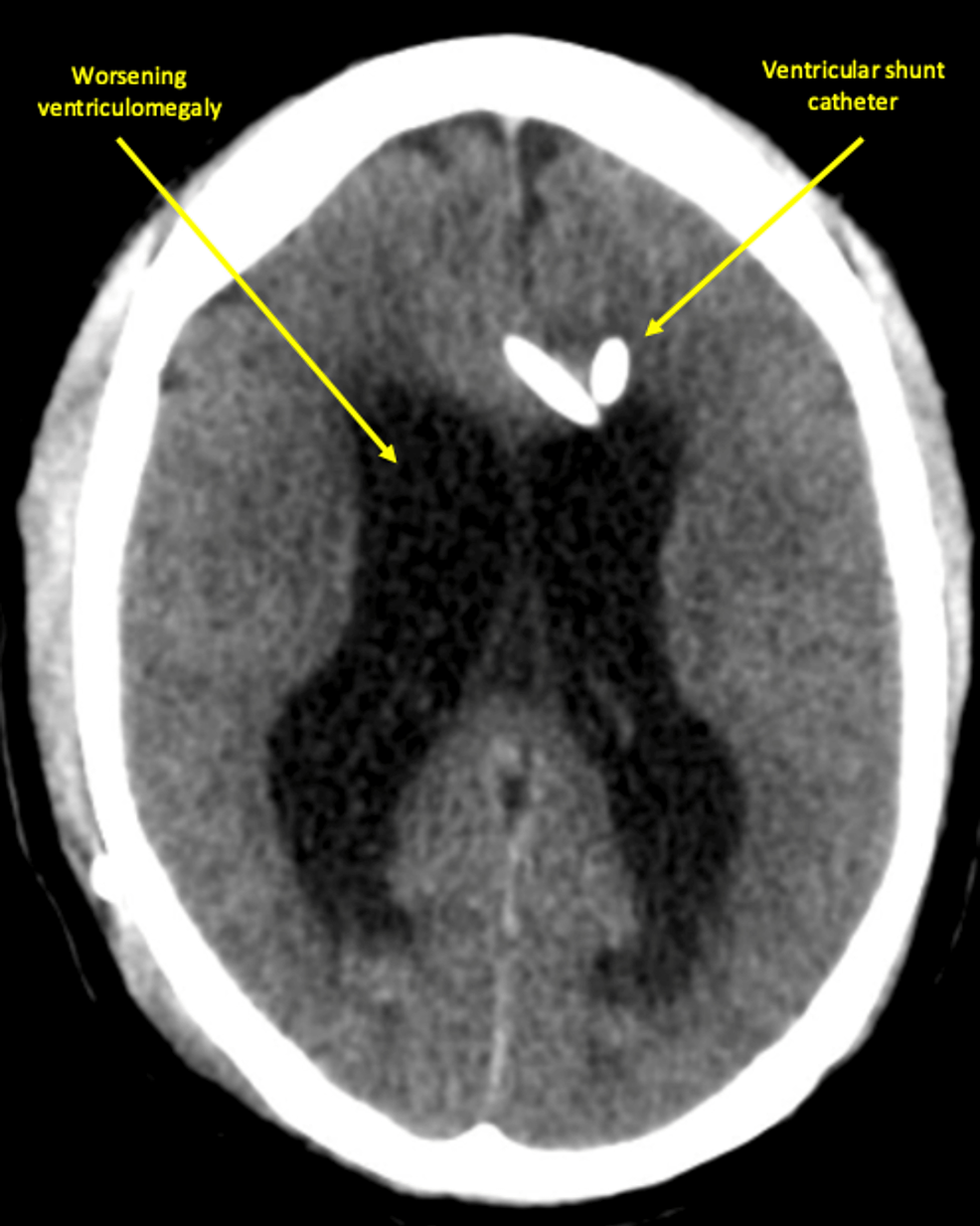 CT-head-without-contrast-on-the-first-day-of-readmission-displayed-ventricular-shunt-catheter-with-new-intraparenchymal-hemorrhage-at-the-right-frontal-lobe-and-extra-axial-hemorrhage-anterior-to-the-left-frontal-lobe.-In-addition,-worsening-ventriculomegaly-concerning-for-worsening-hydrocephalus-was-also-seen.