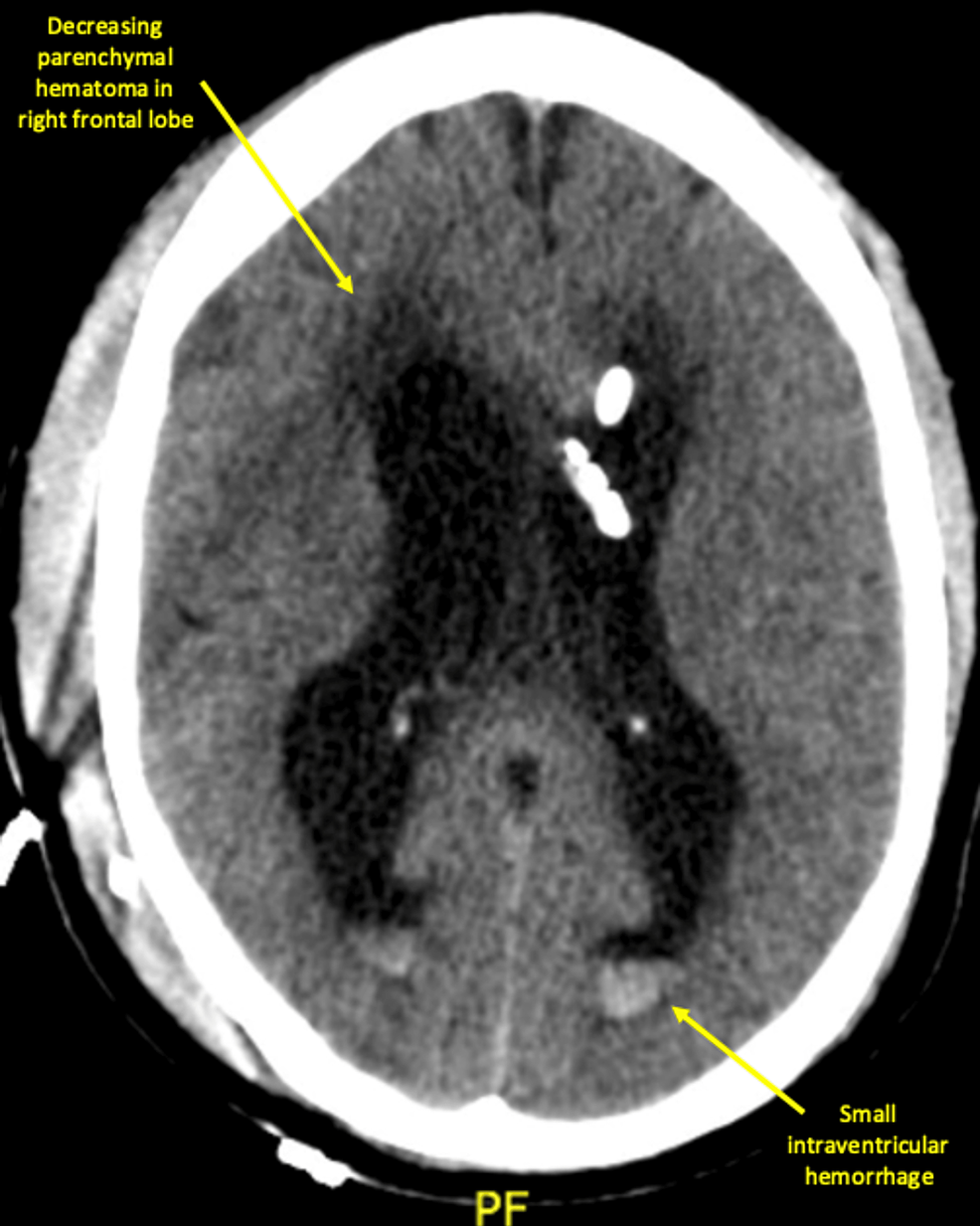 CT-head-without-contrast-on-day-3-of-the-first-readmission-showed-a-decreasing-parenchymal-hematoma-in-the-right-frontal-lobe-adjacent-to-the-shunt-catheter-but-only-a-minimal-decrease-in-size-in-the-lateral-and-third-ventricles.-There-was-also-a-small-amount-of-intraventricular-hemorrhage-and-a-small-amount-of-pneumocephalus.-