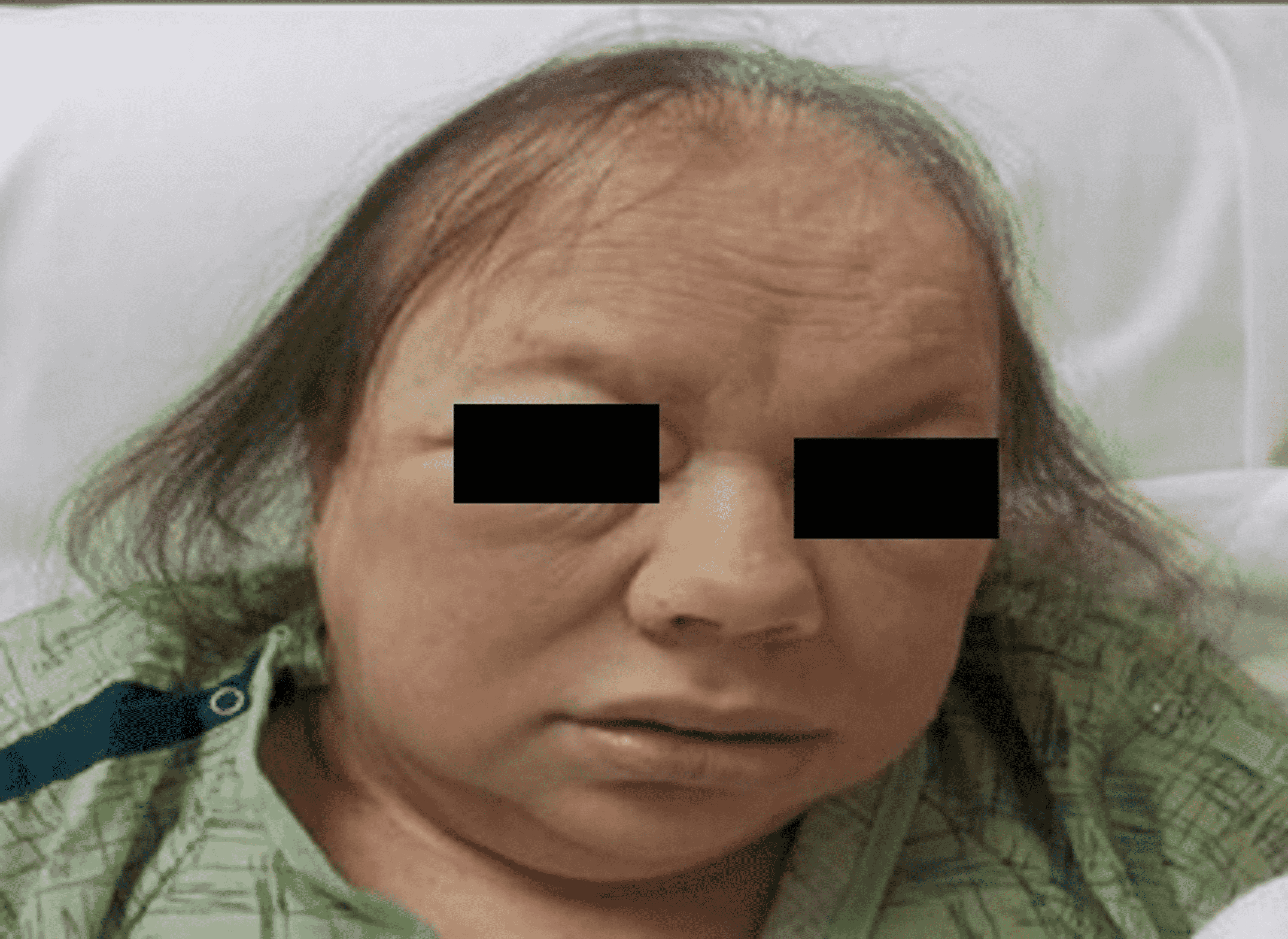 periorbital edema hypothyroidism