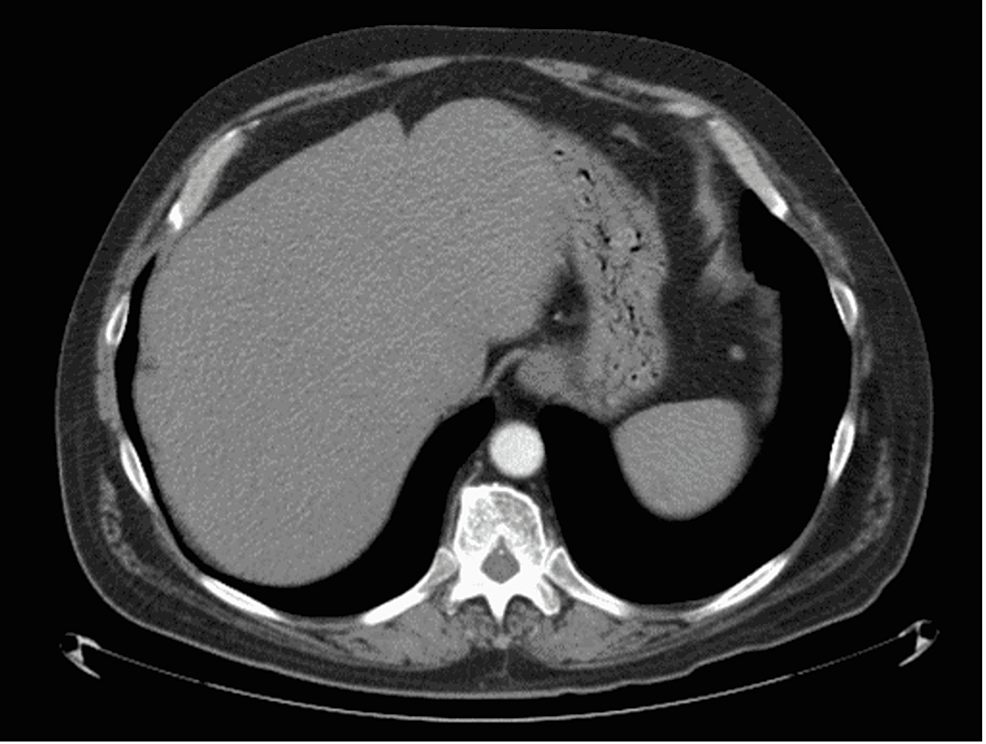 CT-of-the-abdomen-and-pelvis-in-February-2022.