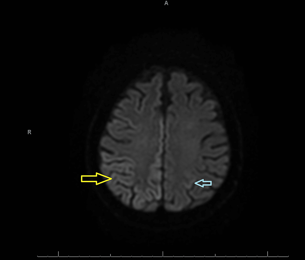 MRI-of-the-brain-without-contrast-(DWI)-displaying-areas-of-curvilinear-hyperintense-signal-in-the-right-parietal,-frontal,-and-temporo-occipital-cortex-(yellow-arrow*)-and-to-a-lesser-extent-in-the-left-parietal-cortex-(blue-arrow)