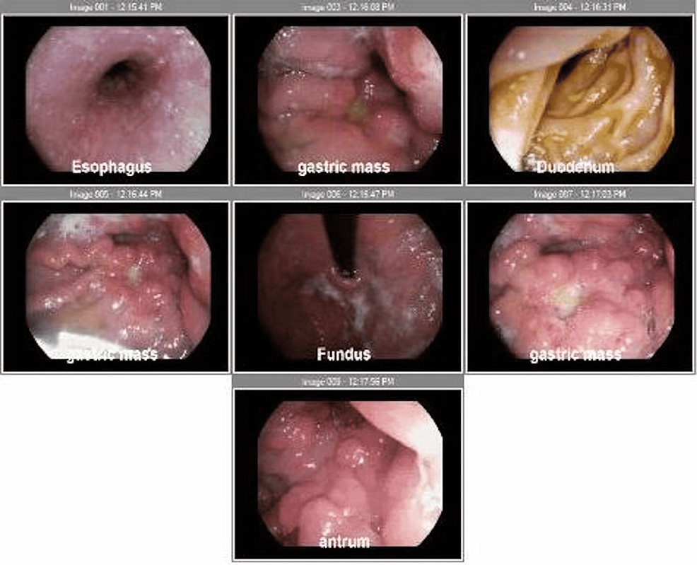 Ophthalmoplegia in a Her2+ and β-hCG+ Patient With Leptomeningeal Carcinomatosis Secondary to Gastric Adenocarcinoma