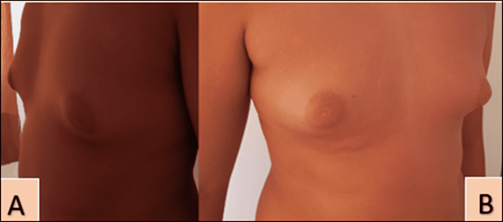 Bilateral-gynecomastia-stage-2-3