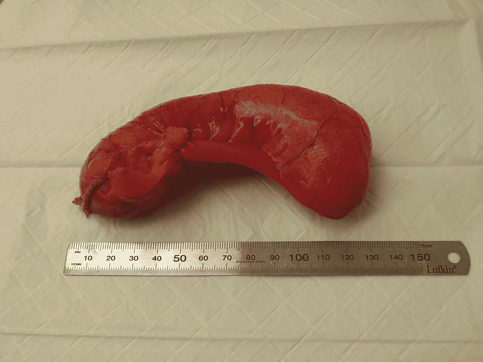 Intact-removed-appendiceal-specimen.