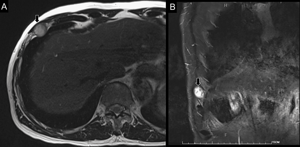 T2-weighted-MRI-of-the-intercostal-tumor-(arrows)-in-the-axial-(A)-and-coronal-(B)-views.