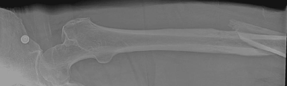 Рентгенова снимка на бедрената кост, показваща-дисталната-изместена-фрактура на бедрената кост- (изглед-2)