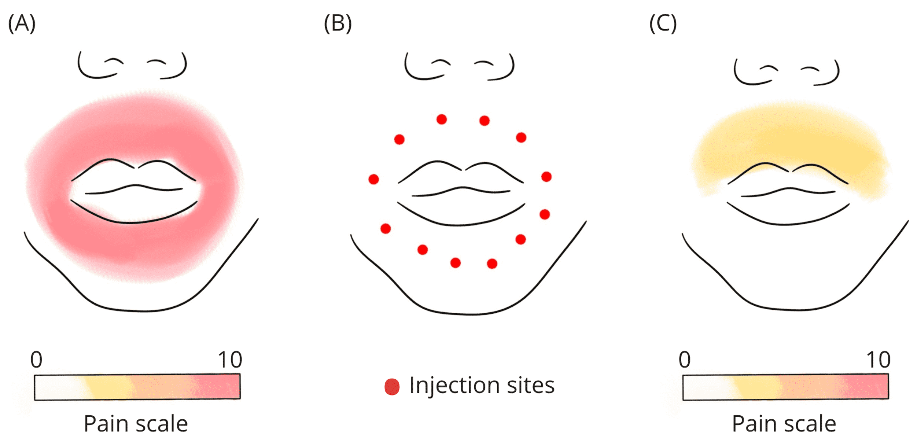 Cureus | Analgesic Effect of Carboxytherapy for Postoperative Neuropathic  Facial Pain: A Case Report