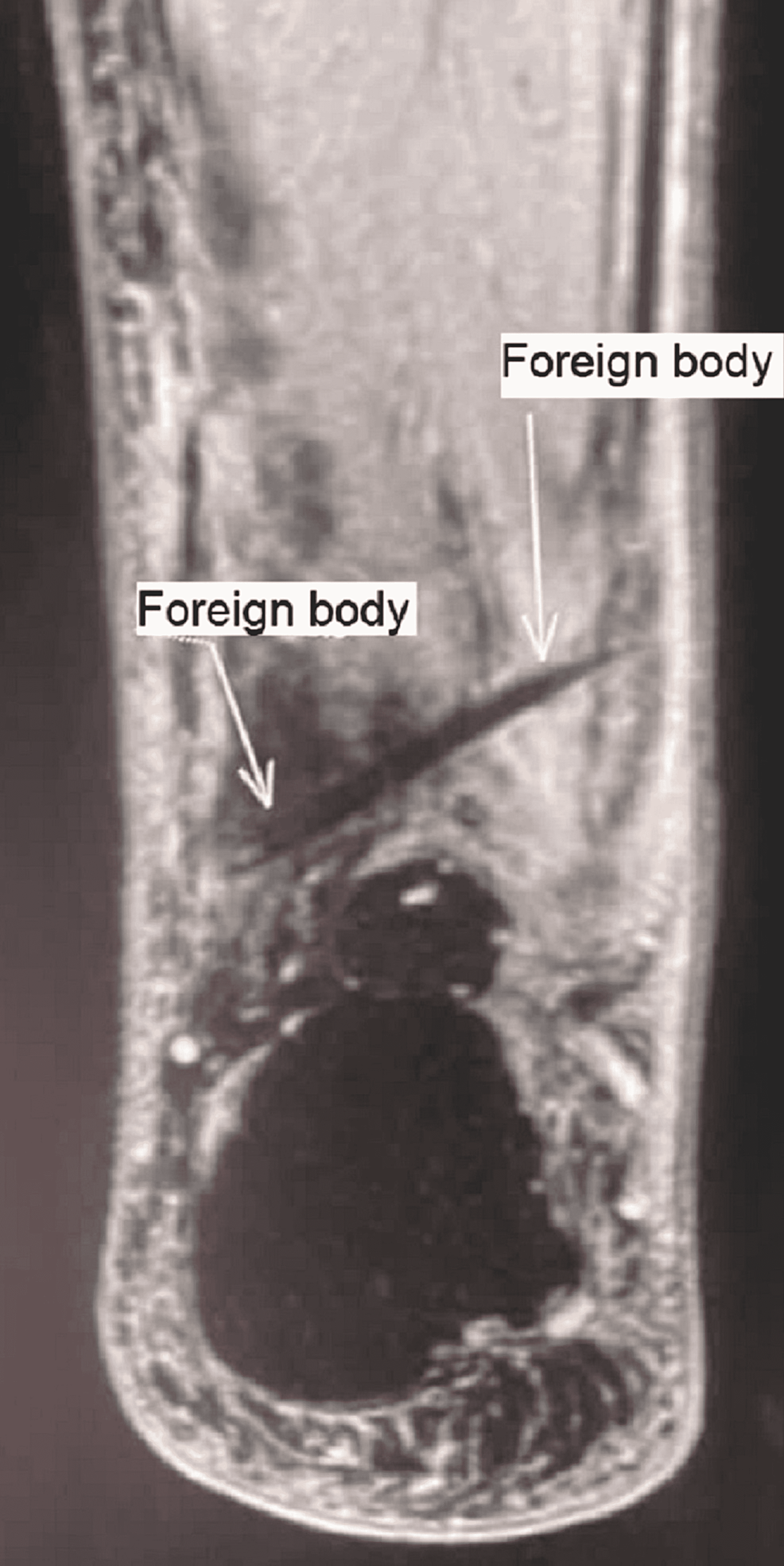 Cureus A New Endoscopic Approach To Remove A Retained Stingray Barb 2742