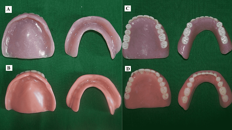 A)-tissue-surface-of-the-patients-new-denture,-B)-tissue-surface-of-the-patients-old-denture,-C)-polished-surface-of-the- -new-patient-denture,-D) -polished-surface-of-patient-old-denture