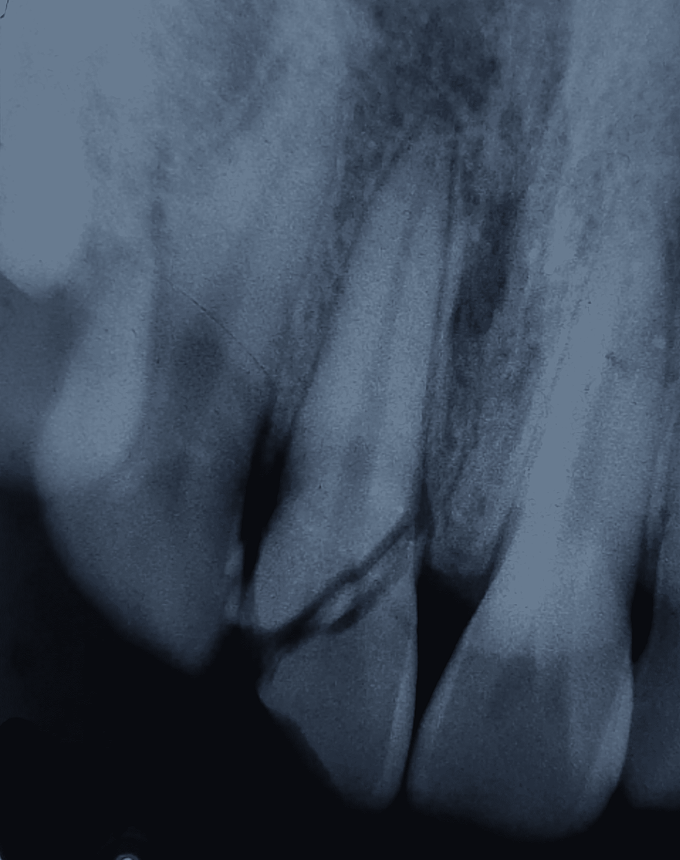 Intraoral-periapical--radiograph-with-respect-to-11---