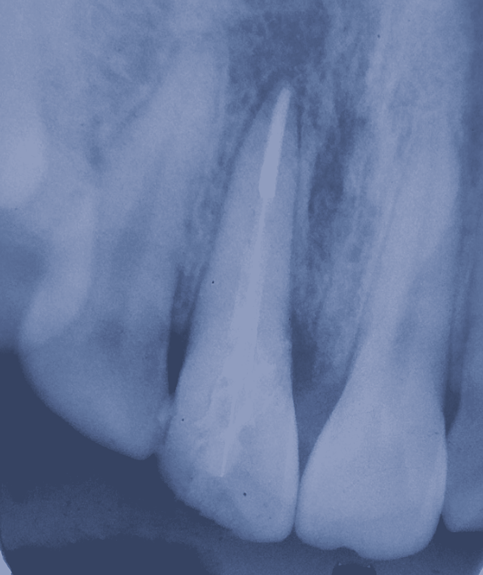 -Intraoral-periapical-radiograph-at-three-month-follow-up
