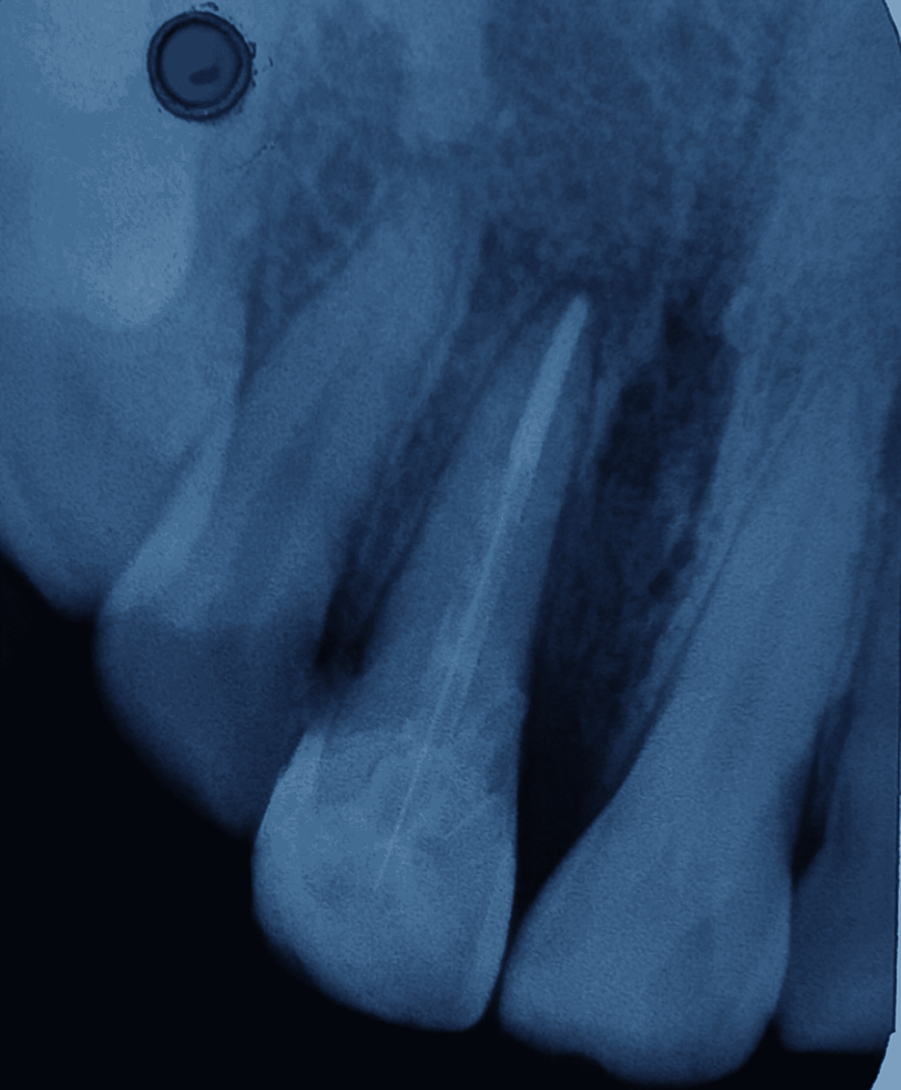 -Intraoral-periapical-radiograph-at-six-month-follow-up