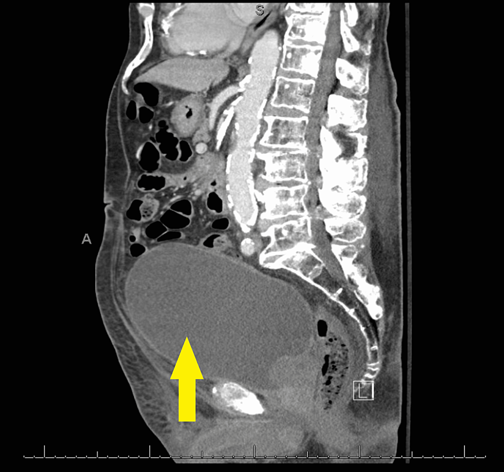Markedly-distended-urinary-bladder-(Yellow-arrow).