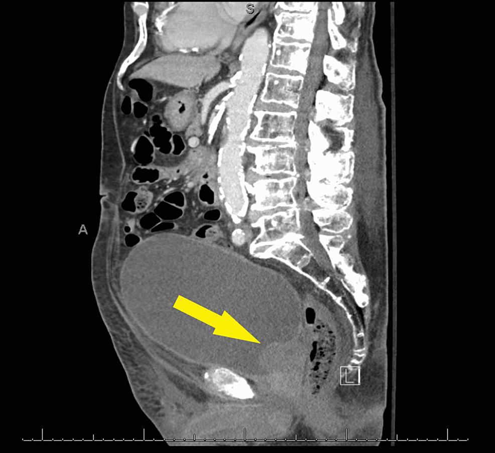 Enlarged-prostate-gland-(Yellow-arrow).