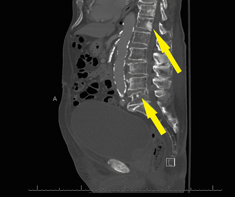 Sclerotic-bony-densities-in-the-spine-consistent-with-metastatic-prostate-carcinoma-(Yellow-arrows).