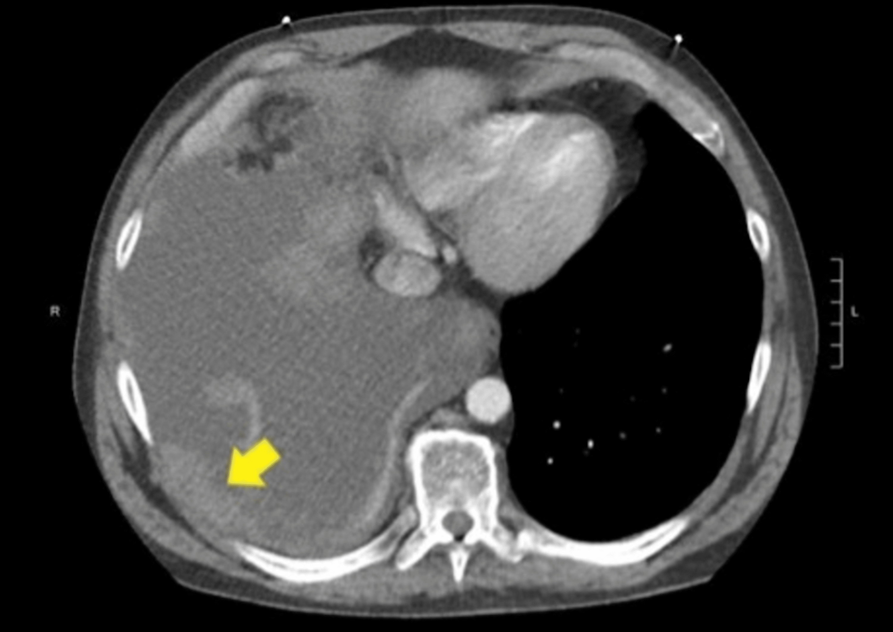 The Great Mimicker: Cutaneous Metastatic Melanoma Presenting As A Non ...