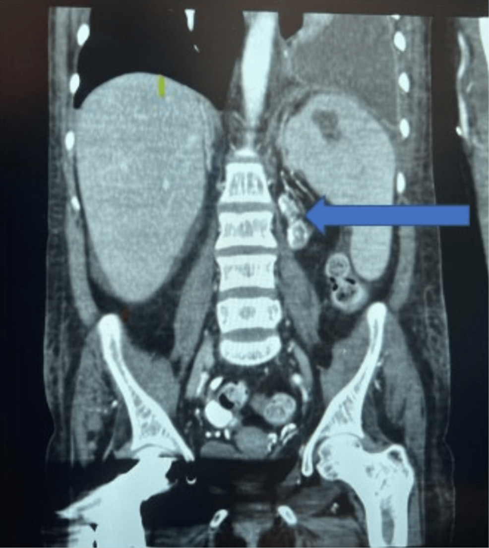 cureus-a-rare-case-of-horseshoe-kidney-with-multiple-atrial-myxomas