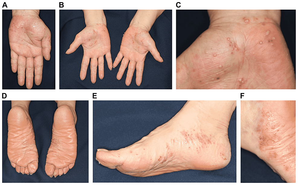 Clinical-images-showing-small-pustules-sporadically-on-the-palms-and-soles-(a)-(f).