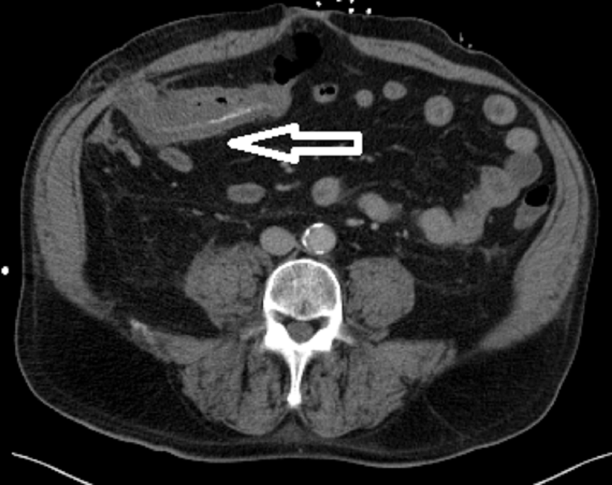 Cureus An Unusual Presentation of Spigelian Hernia Incarceration