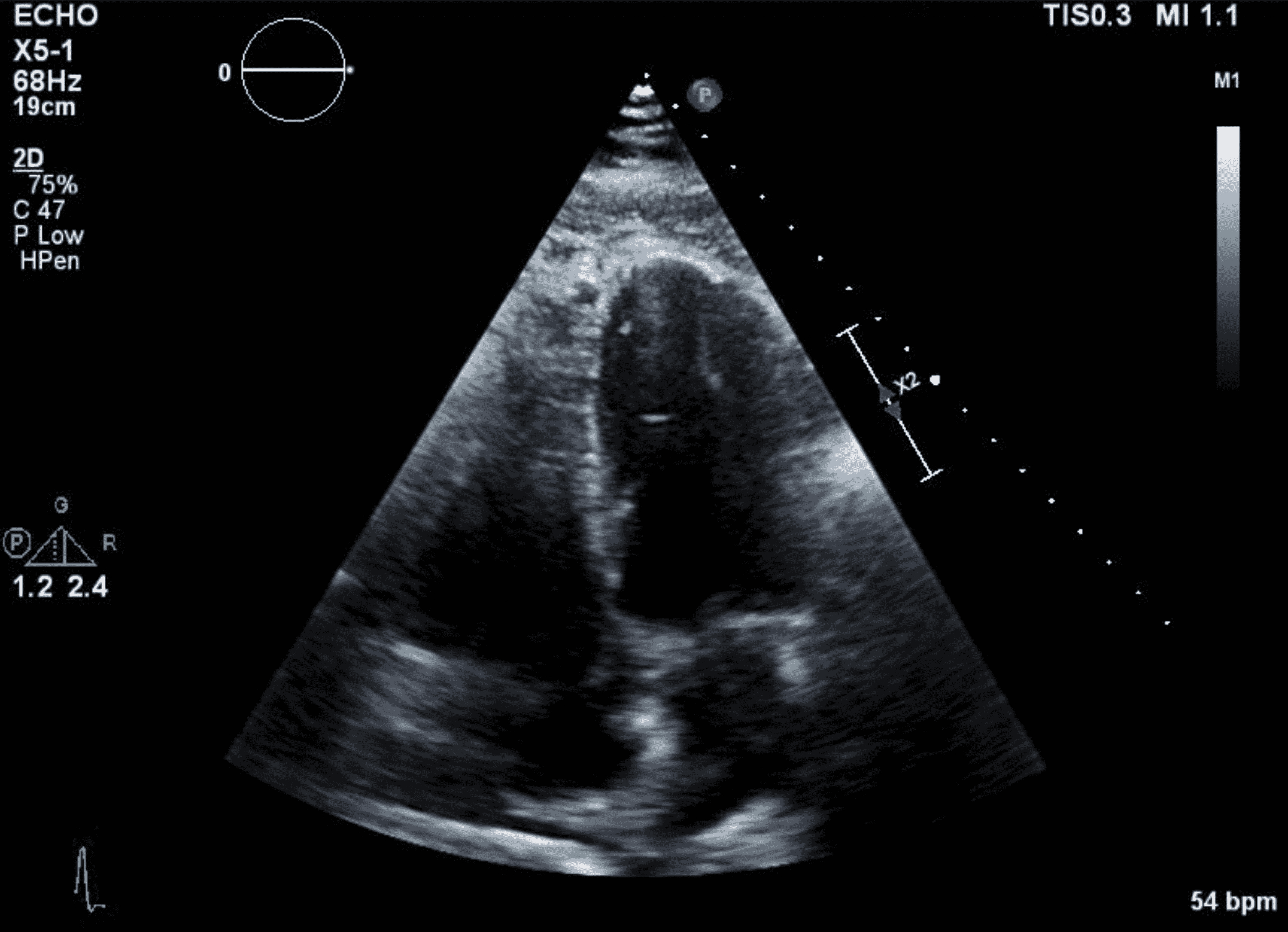 Cureus | Left Anterior Descending Artery to Pulmonary Artery Fistula: A ...