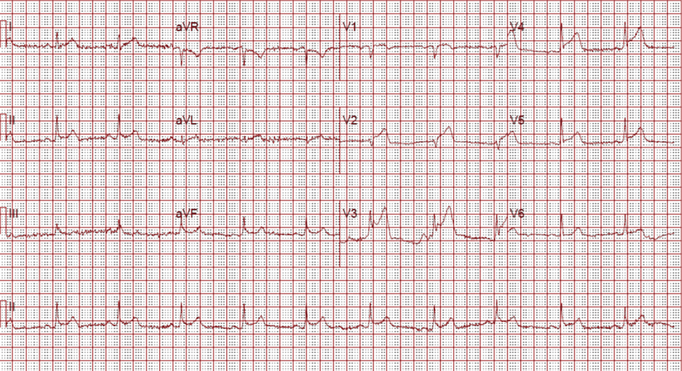 Cureus | Left Anterior Descending Artery to Pulmonary Artery Fistula: A ...