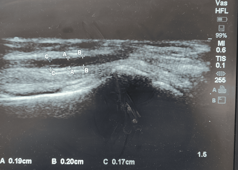 Measurement-of-radial-artery-flow-mediated-vasodilatation