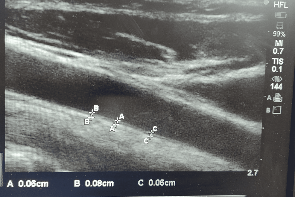 Measurement-of-carotid-artery-intima-media-thickness