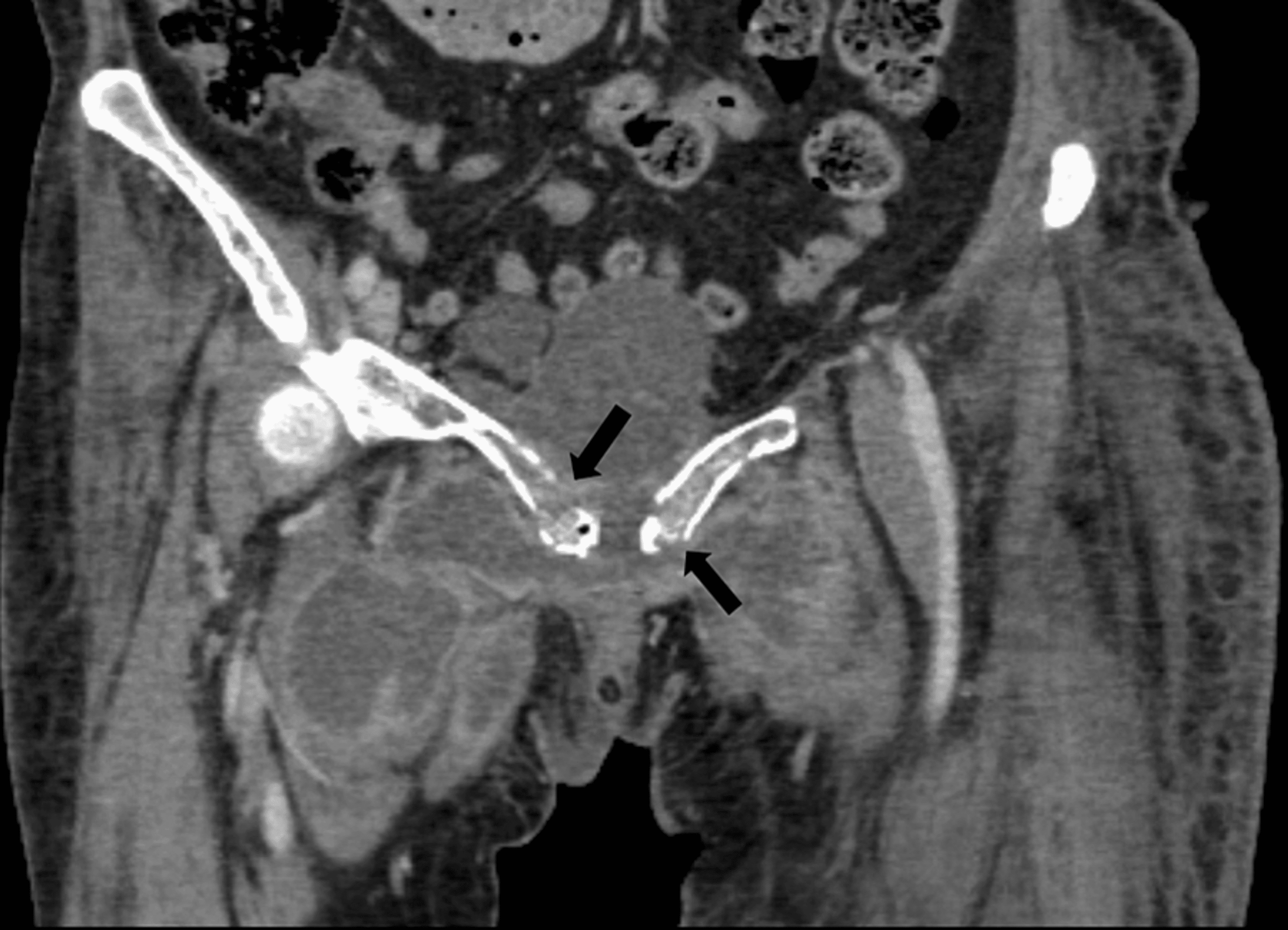 Cureus A Rare Facultative Anaerobe Causing Emphysematous