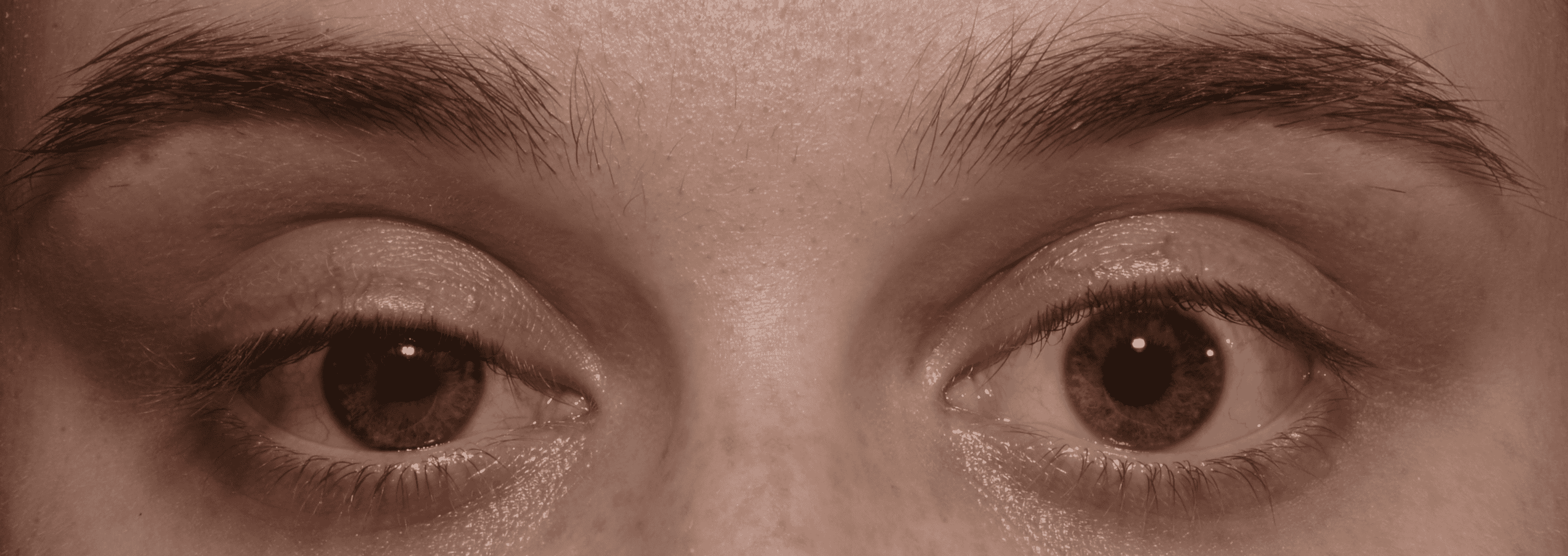 Cureus Postoperative Horner's Syndrome Following Total Thyroidectomy