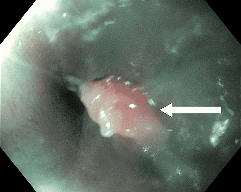 Nodule-seen-at-gastroesophageal-junction.