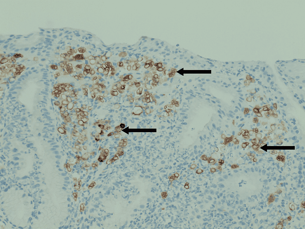 CD79a-stain-to-confirm-the-presence-of-plasma-cells-with-Russell-bodies.
