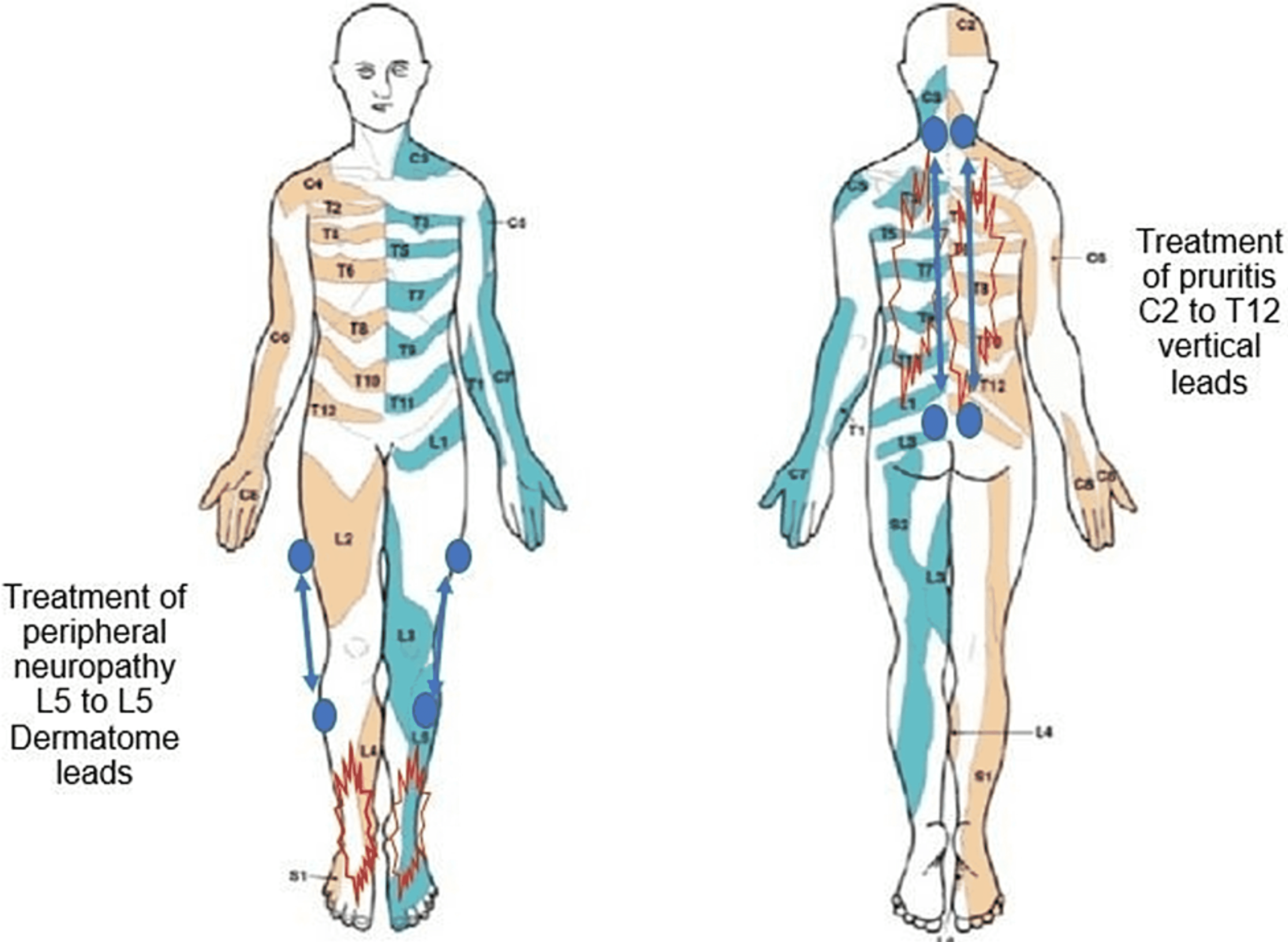 Light Treatment For Peripheral Neuropathy Shelly Lighting