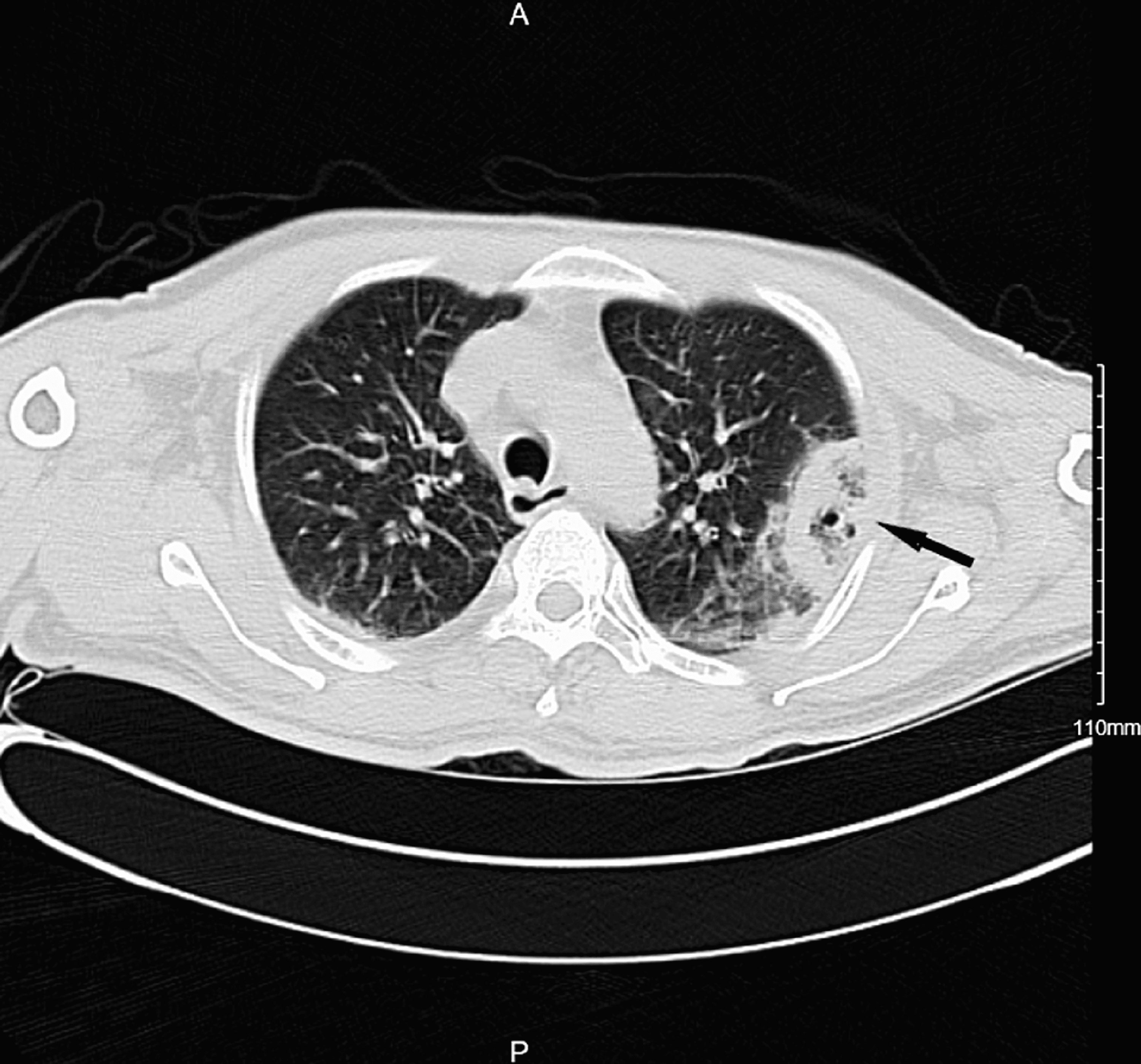 mycetoma ultrasound