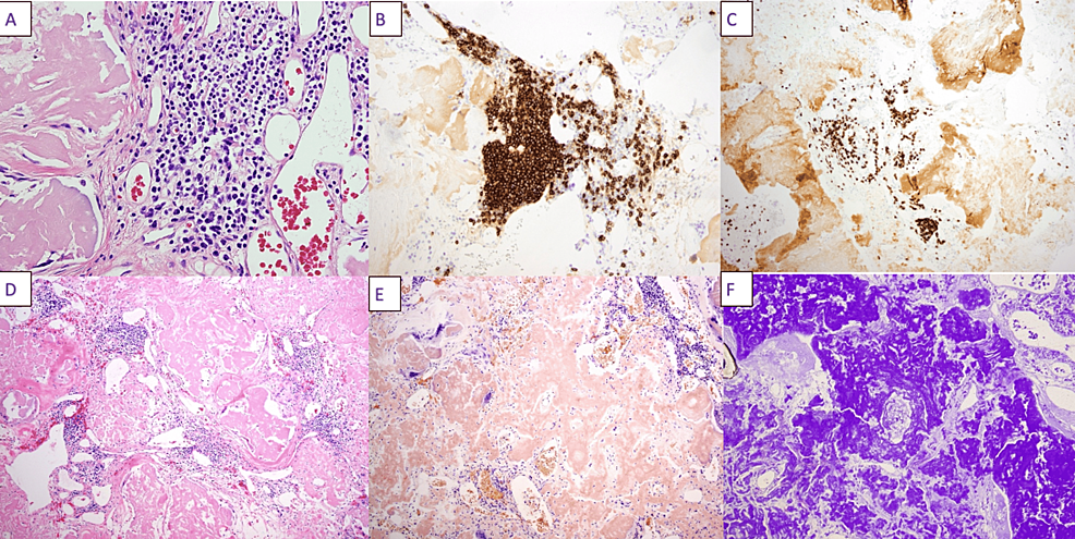 Pathology-slides-of-the-left-groin-mass.