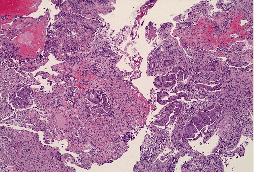 Cureus | Metastatic Rectal Adenocarcinoma in Familial Adenomatous ...