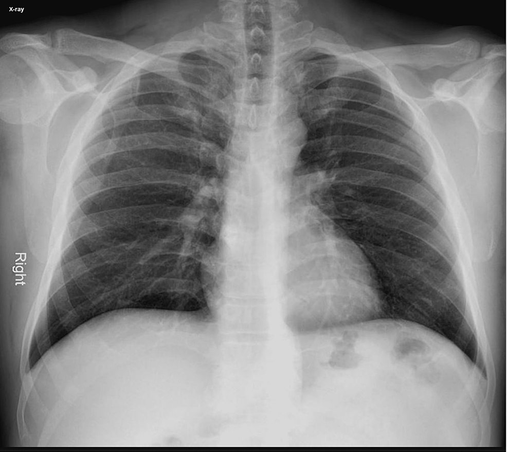 Ivermectin-Induced Acute Psychosis in Patients Infected With COVID-19 Pneumonia